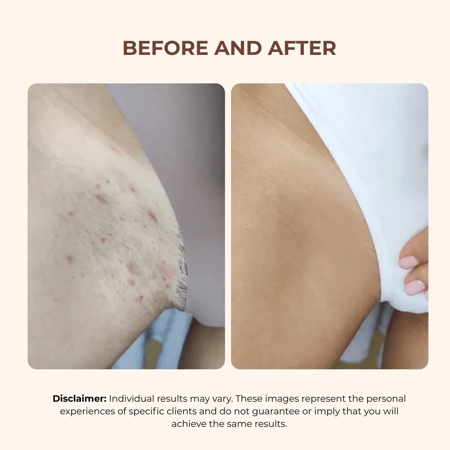 BBL Serum - 3-In-1 Bikini Line Serum - Designed for Ingrown Hairs, Dark Spots, Razor Bumps, and Irritation