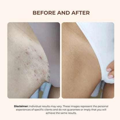 BBL Serum - 3-In-1 Bikini Line Serum - Designed for Ingrown Hairs, Dark Spots, Razor Bumps, and Irritation