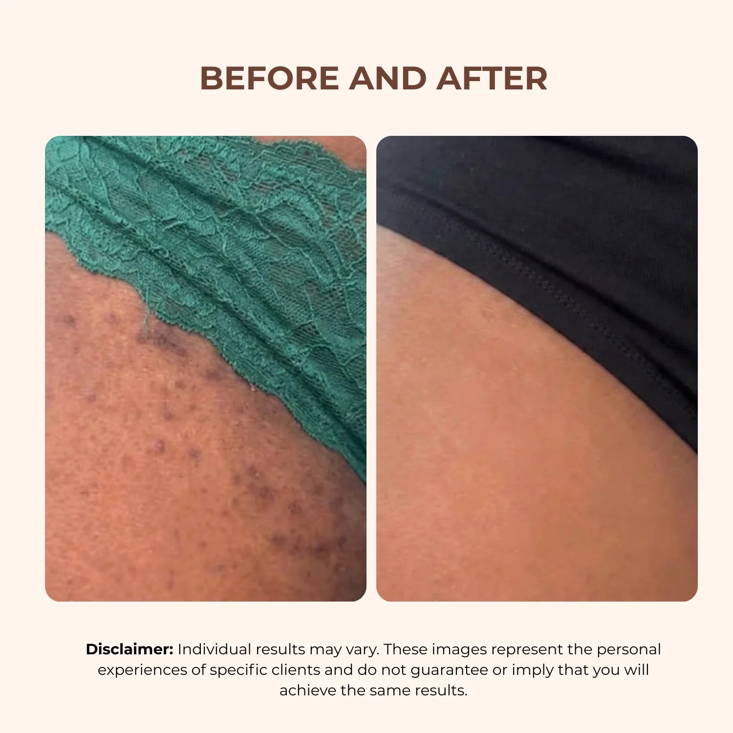 BBL Serum - 3-In-1 Bikini Line Serum - Designed for Ingrown Hairs, Dark Spots, Razor Bumps, and Irritation